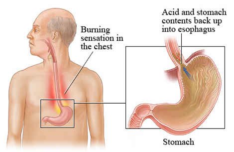 gastroparesis-treatment.jpg