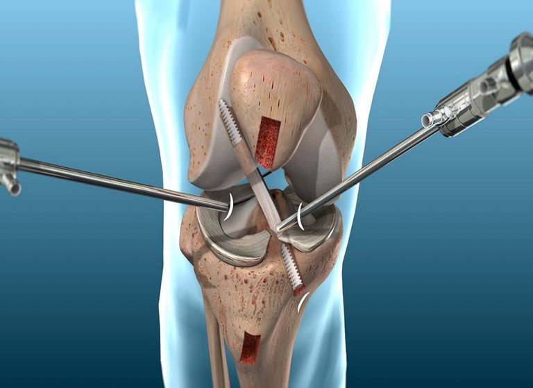 ACL-Reconstruction-1024x745.jpg