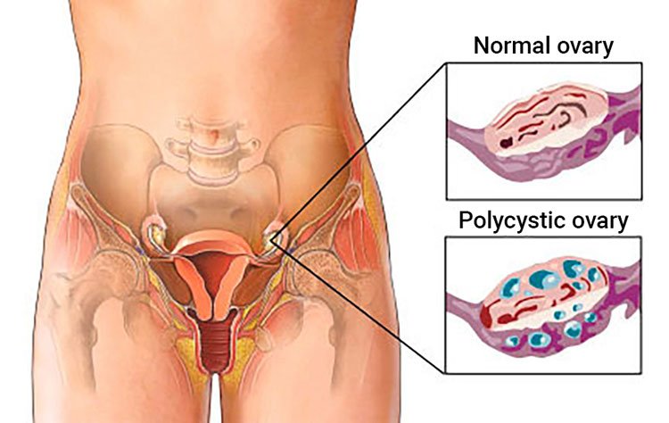 pcos-diagram.jpg