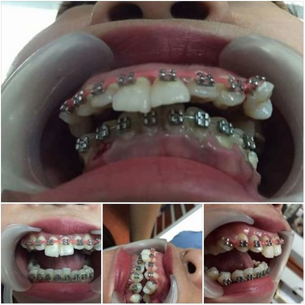 476b51e6d9e463ada76683b09c2cff3e--teeth-alignment-dental-braces.jpg