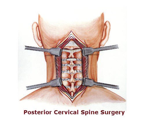 cervical-spine-surgery.jpg