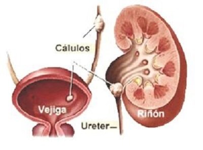 Litiasis-renal-causas.jpg