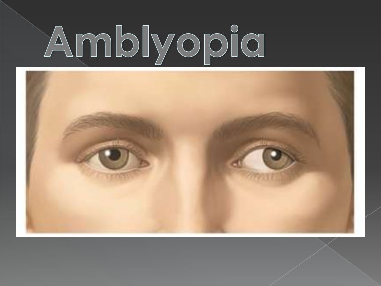 amblyopia-120207190855-phpapp02-thumbnail-4.jpg