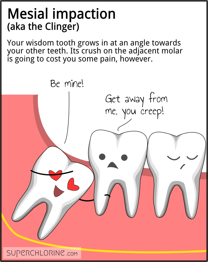 wisdom-teeth-types_mesial.png