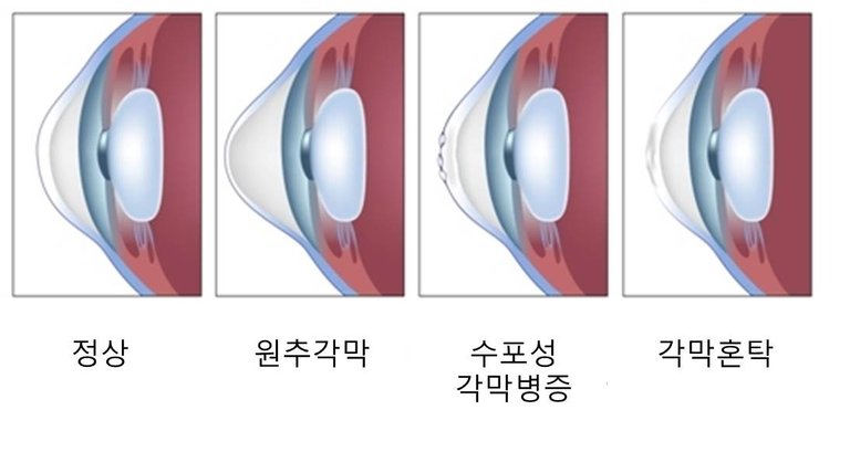 불규칙난시.jpg