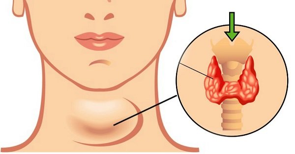 Symptoms-of-Hypothyroidism.jpg