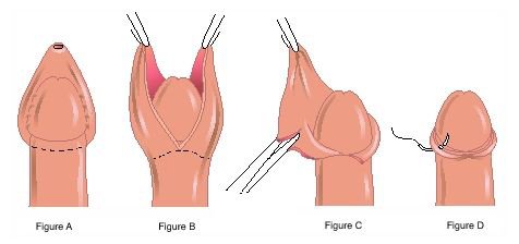 circumcision1.jpg