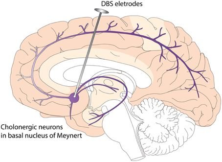 Deep_Brain_Stimulation_(DBS)_of_Nucleus_Basalis_of_Meynert.jpg