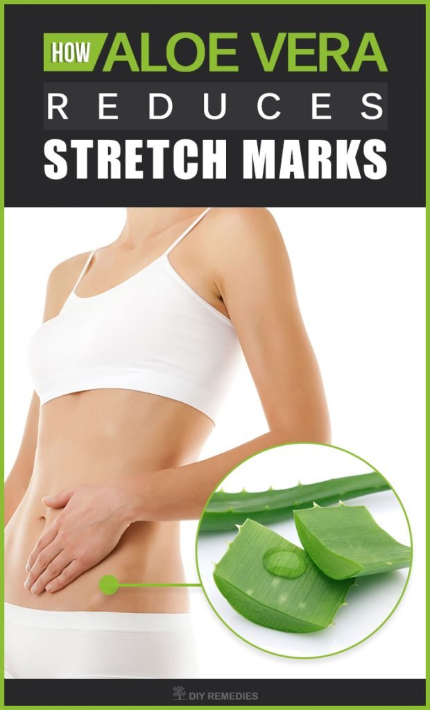 How-Aloe-Vera-Reduces-Stretch-Marks-620x1024.jpg