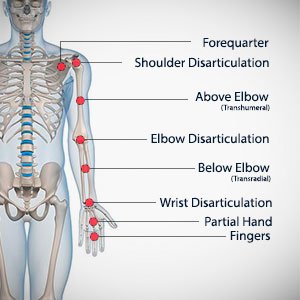 arm-amputation-types.jpg