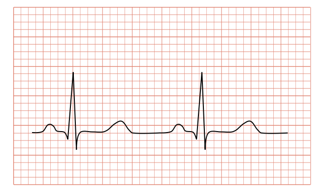 660px-Normal_ECG_2.svg.png