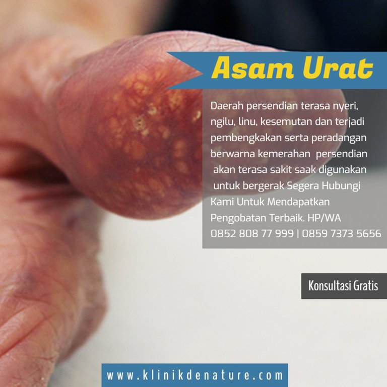 obat asam urat terbaik.jpeg