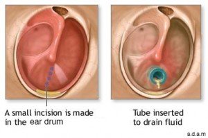 tube-insertion-300x199.jpg