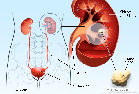 kidney-stone.jpg
