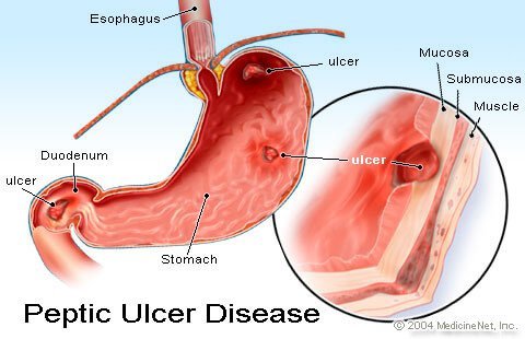 peptic_ulcer.jpg