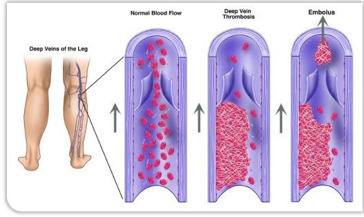 deep-vein-thrombosis.jpg