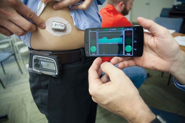 Artificial-Pancreas.jpg