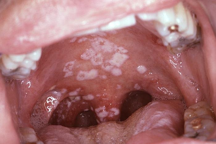Chlamydia-in-Throat-Oral-Chlamydia.jpg