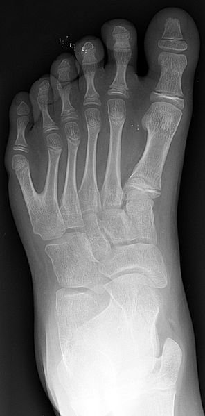 Polydactyly_01_Lfoot_AP.jpg