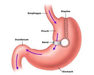 vertikalna zaomčena gastroplastika.jpg