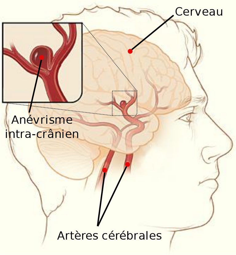 Cerebral_aneurysm-fr.svg.png