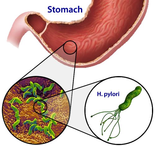 helicobacter_pylori.jpg