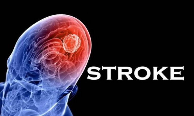 stroke-kini-serang-usia-produktif-penggunaan-gadget-salah-satu-pemicu-I8lieU7Wa7.jpg