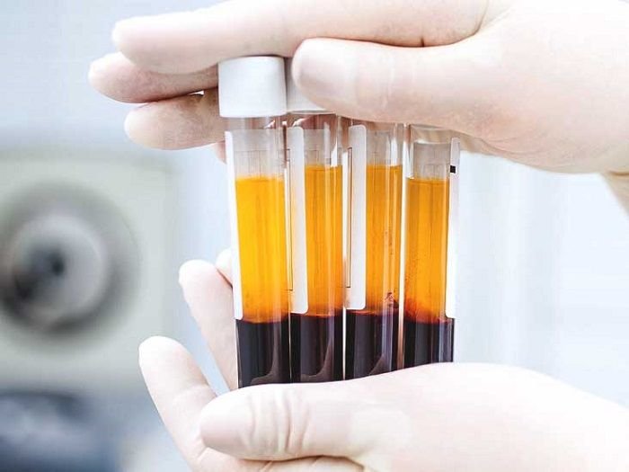 Platelet Rich Plasma.jpg