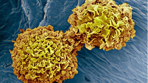 _98681534_m1220387-breast_cancer_cells_sem-spl.jpg