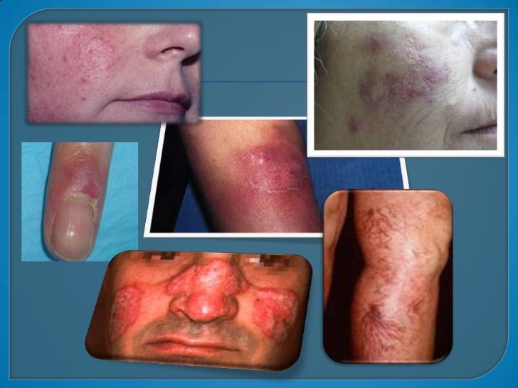 enfermedades-del-tejido-conectivo-dermatologia-11-728.jpg