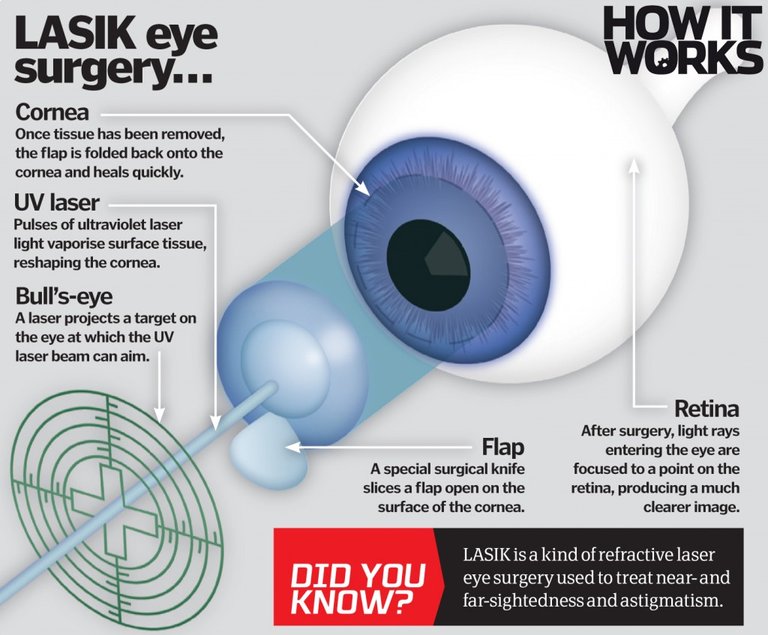 lasik how it works.jpg