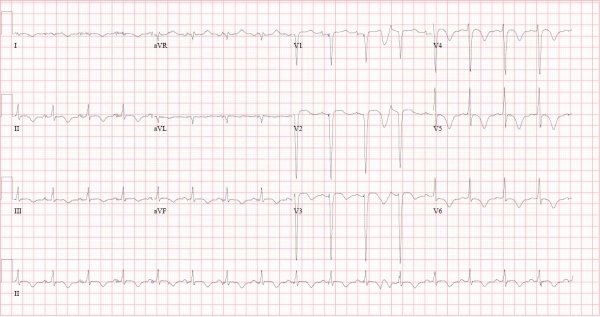 apa gambaran EKG.jpg