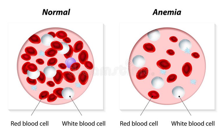 anemia-47873169.jpg