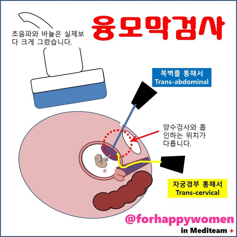 융모막검사.jpg