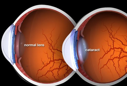 webmd_rm_photo_of_cataract_illustration.jpg