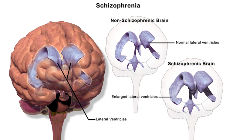 Schizophrenia_(Brain).png