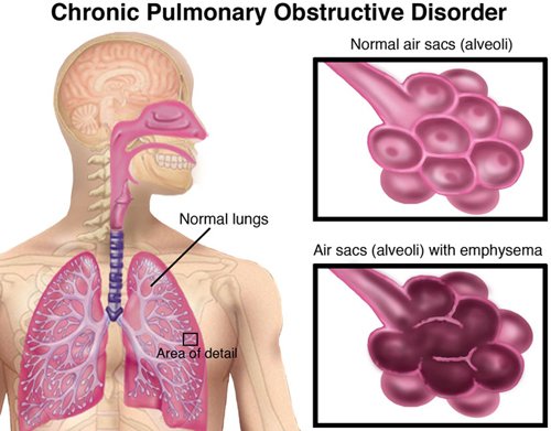 COPD-Small.jpg