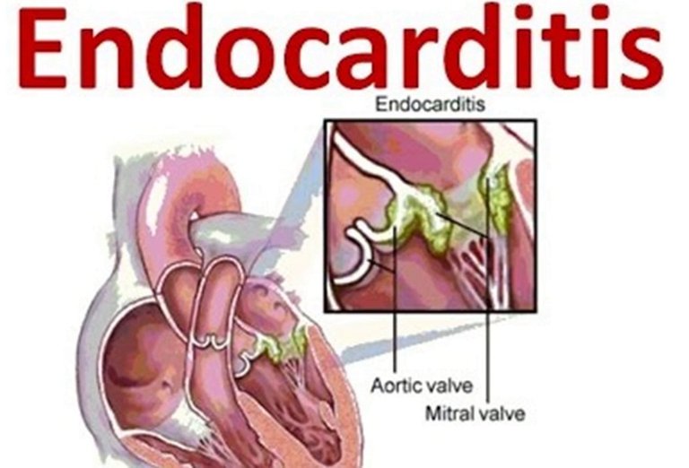 Infective-Endocarditis.jpg