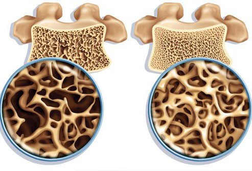 Osteoporosis (1).jpg