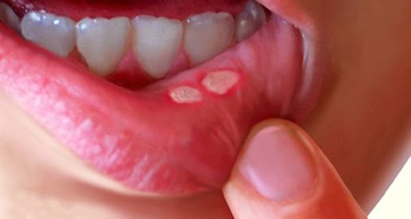 cankersore_Mouth_ulcer.jpg