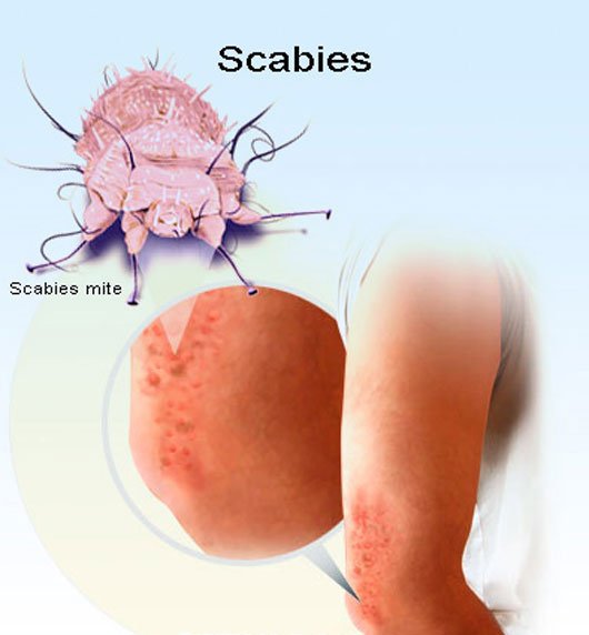 scabies2.jpg