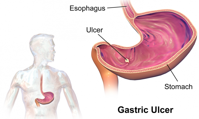 ulcer-696x418.png