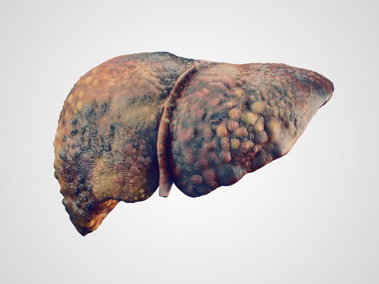 illustration-of-a-diseased-liver.jpg