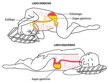 post-solucionreflujo-gastrico.jpg