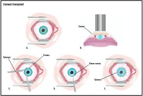 coneal-implant1.jpg