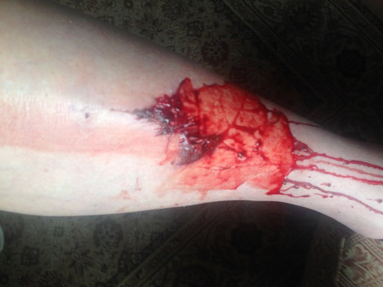 shin injury bloody.jpg