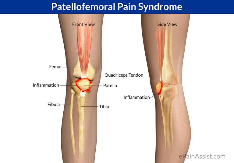 Patellofemoral-Pain-Syndrome.jpg