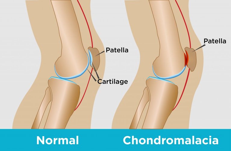 Knee Chondro.jpg