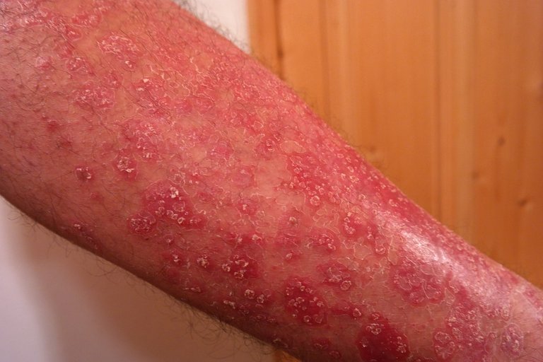 psoriasis-356429_960_720.jpg