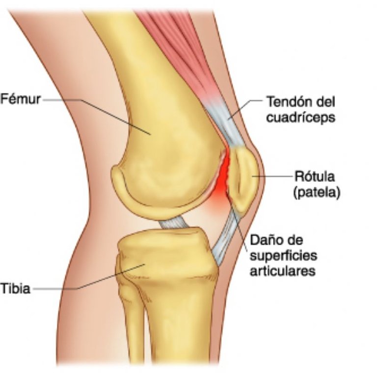 SindromeFemoro-Patelar.jpg